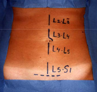 localisationde la cicatrice
