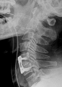 Cage + plaque en C5C6