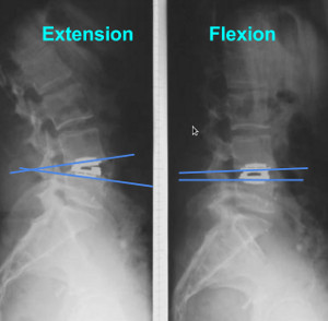 mobilités prothétique
