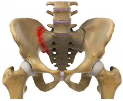 Myélopathie cervicale